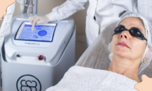 Laser Pisom – Tratamento de Rejuvenescimento, couro cabeludo e manchas • Intensivo